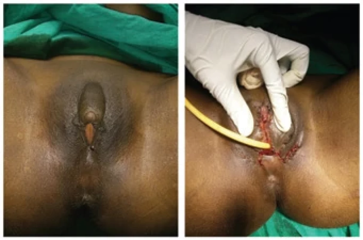 Preoperative and postoperative pictures of another case of congenital adrenal hyperplasia with ambiguous genitalia.