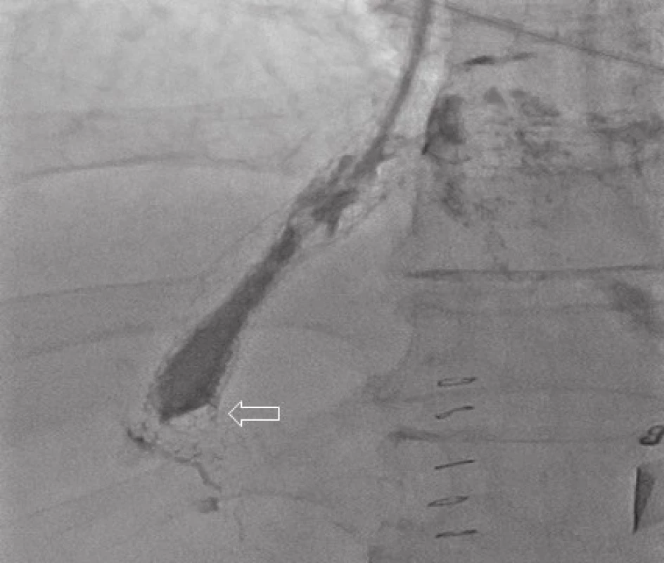 Angiografický nález − okludovaný TIPS trombem
Fig. 1: Angiographic fading − TIPS occlusion due to thrombosis