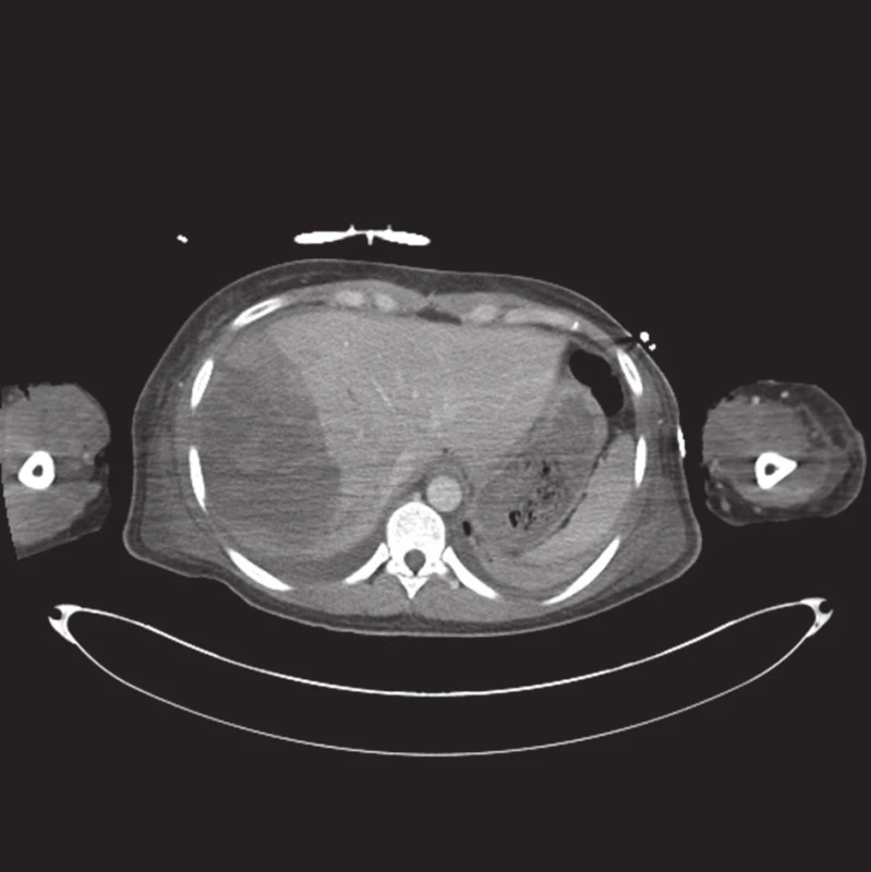 Kontrolní vyšetření 3. den po úrazu. Rozsáhlý hematom v pravém jaterním laloku
Fig. 2. Follow-up examination 3rd day after the injury. Large hematoma in the right lobe of liver