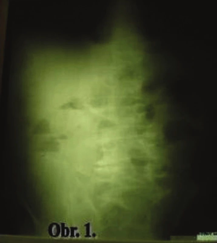 Ileus na RTG snímke
Fig. 1: Ileus in an X-ray image