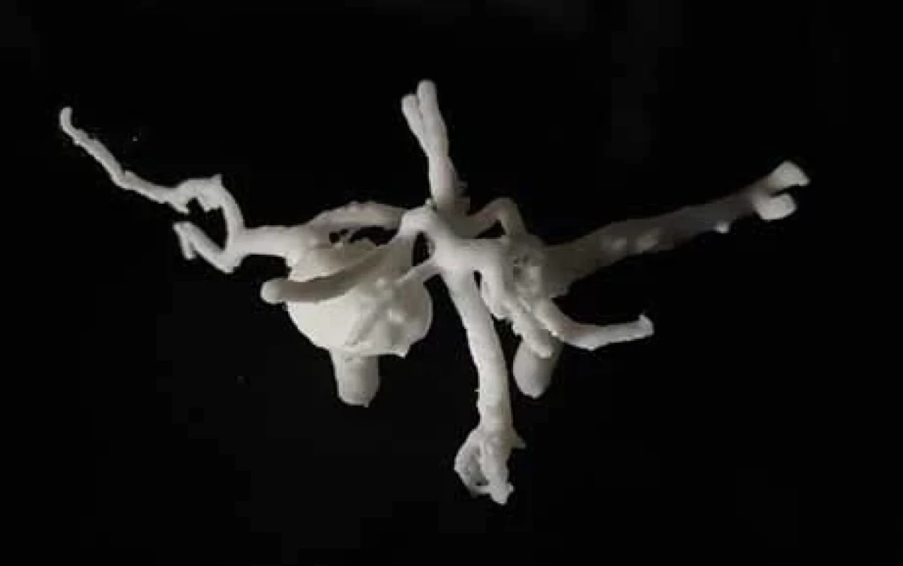 3D model of an aneurysm in the branching of the middle cerebral artery.