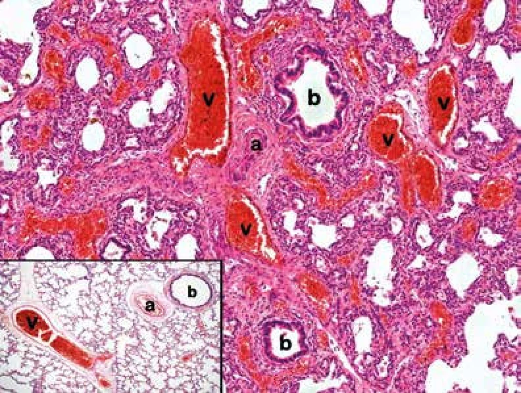 Nekroptický vzorek plicní tkáně s charakteristickými změnami pro ACD/MPV: anomální uspořádání bronchovaskulárního svazku – vychýlené plicní žíly (v) probíhající společně s tepnou (a) a bronchiolem (b). Dále patrná výrazná venostáza, formování žilních prstenců kolem bronchiolů a široká alveolární septa s redukovaným počtem kapilár, v centru alveolárních sept lokalizovány ektatické cévní prostory (HE 100x). Ve výřezu vlevo dole vzorek normálně anatomicky uspořádané plicní tkáně s plicní žilou (v) probíhající odděleně od bronchovaskulárního svazku (arterie (a), bronchus (b)). (HE 40x)