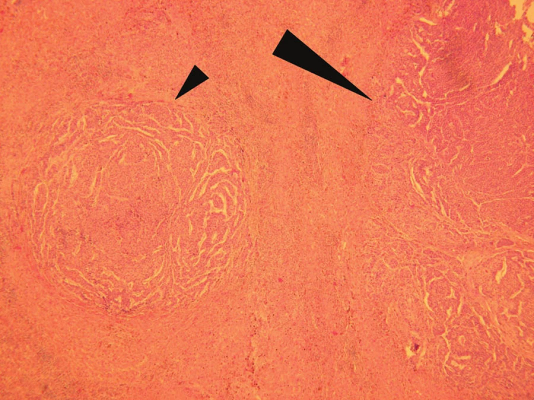 Histologické vyšetření: jaterní metastáza adenokarcinomu žaludku (velká šipka) s dceřiným ložiskem charakteru mikrometastázy v jeho těsné blízkosti (malá šipka). Barvení hematoxylin-eosin, zvětšení 100x
Fig. 5: Histopathological investigation: liver metastasis form gastric cancer (large arrow) with satellite micrometastasis in its close proximity (small arrow). Hematoxylin-eosin staining, magnified 100x