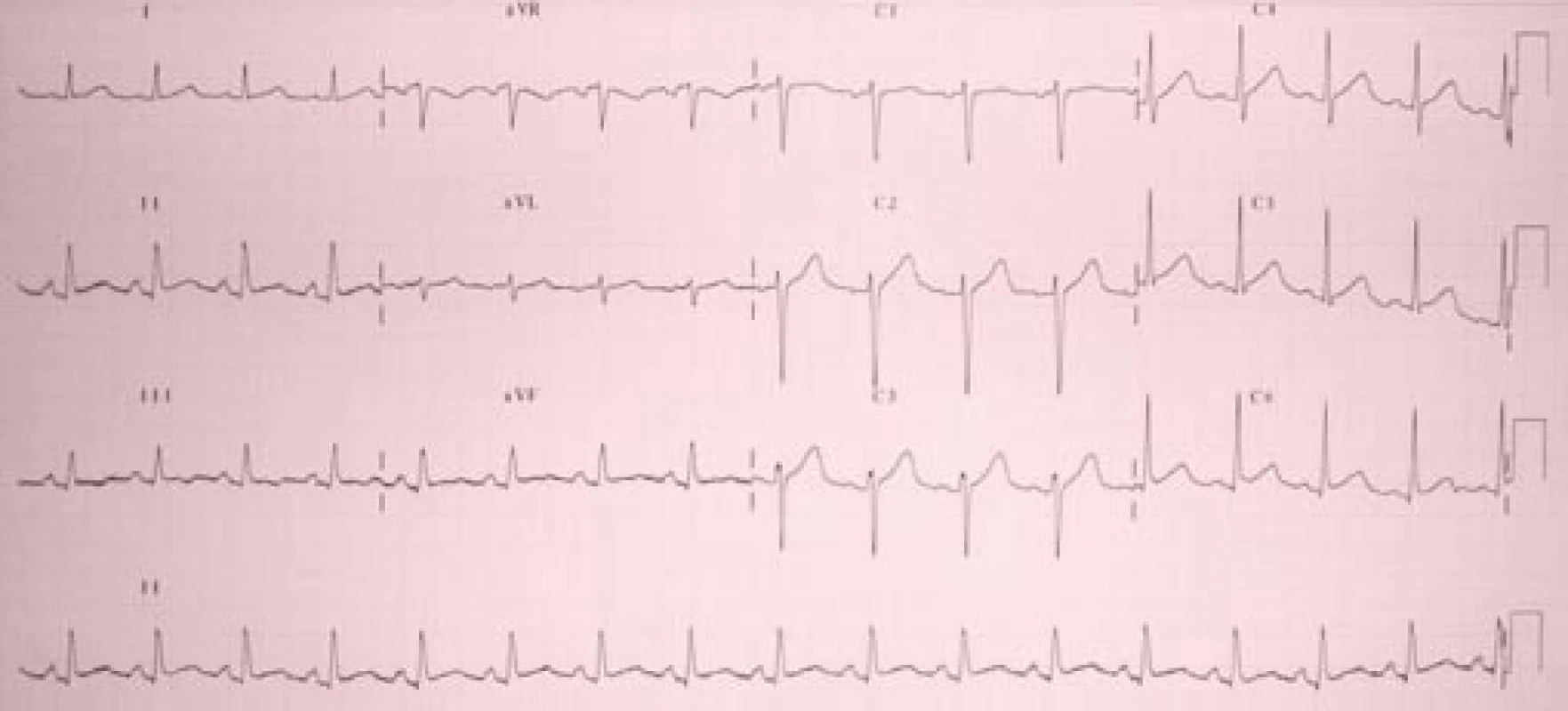Vstupní EKG.