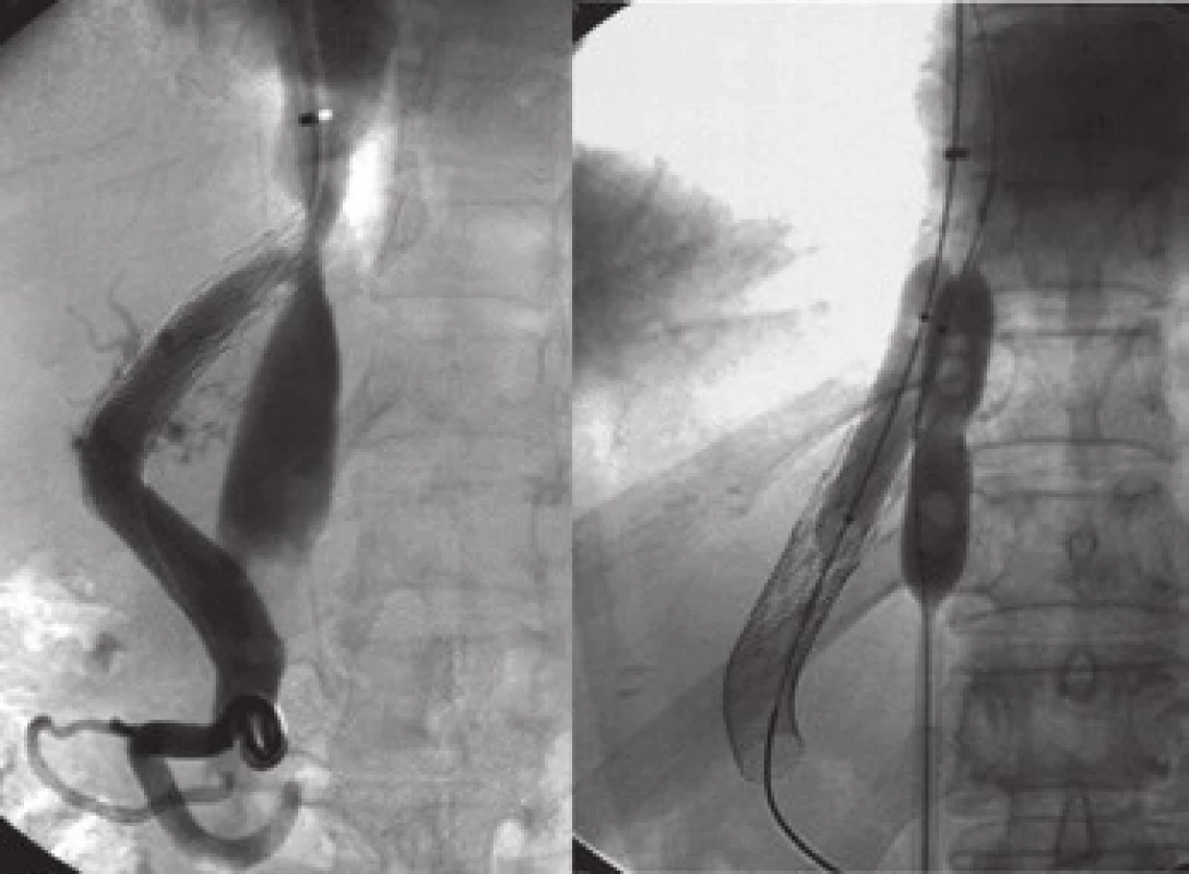 Obraz paralelního stentování dolní duté žíly při její významné stenóze hypertrofickou jaterní tkání.
Fig. 3. Picture of parallel stenting of inferior vena cava in significant stenosis by hypertrophic liver tissue.