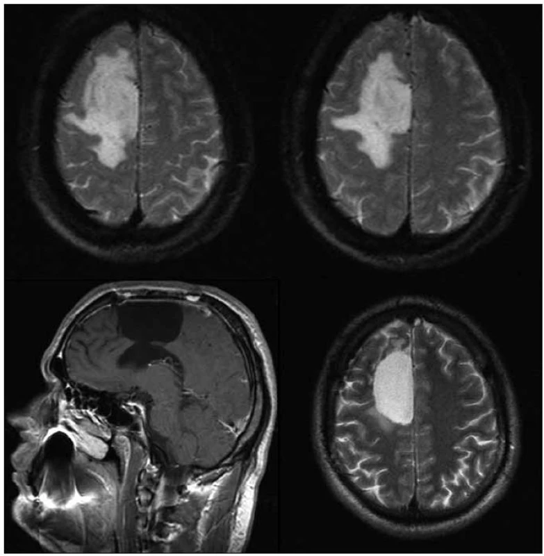 27letý pacient po subtotální resekci oligodendrogliomu gr. II gyrus frontalis superior, gyrus cinguli a corpus callosum vpravo v roce 2007, v roce 2009 grafická enhancující progrese v precentrálním gyru, léčen PCV s dobrou reakcí a grafickou i klinickou normalizací stavu.
