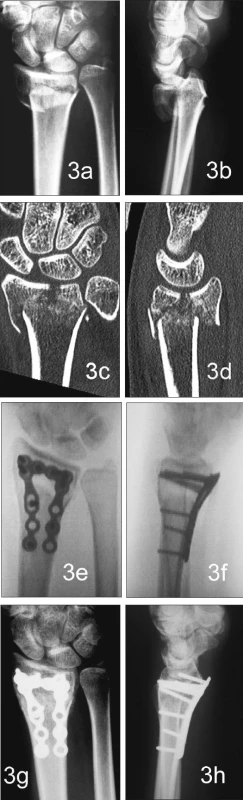 Zlomenina distálního radia typu C.2. (a, b, c, d), osteosyntéza rámovou dlahou systému Aptus radius (e, f), kostní hojení po 8 týdnech (g, h)
Fig. 3. The distal radius fracture, type C.2. (a, b, c, d), osteosynthesis with the Aptus radius frame plate (e, f), the bone healing at 8 weeks (g, h)