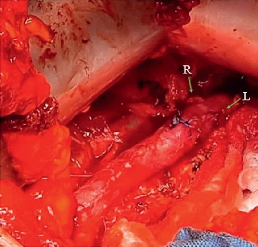 Retroperitoneal approach of the abdominal aorta through the left pararectal incision. Retroperitoneální přístup k abdominální aortě přes levou pararektální incizi.