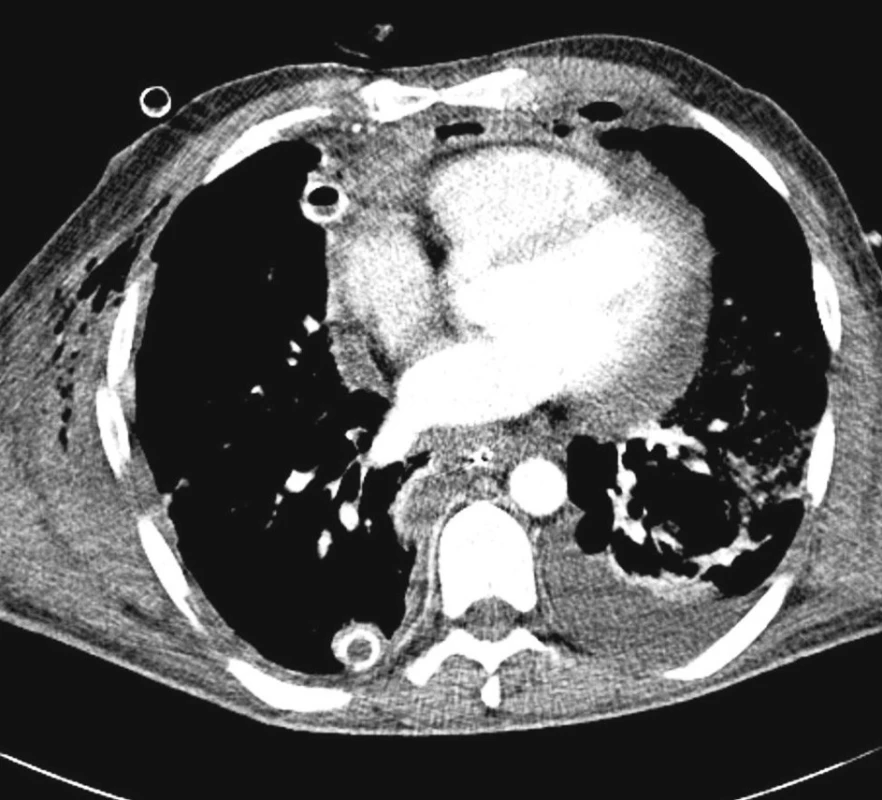 Axiální obraz CT s kolekcí retrosternálně, oboustranný pleurální výpotek
Fig. 3. Axial CT view with a retrosternal density, bilateral pleural effusion