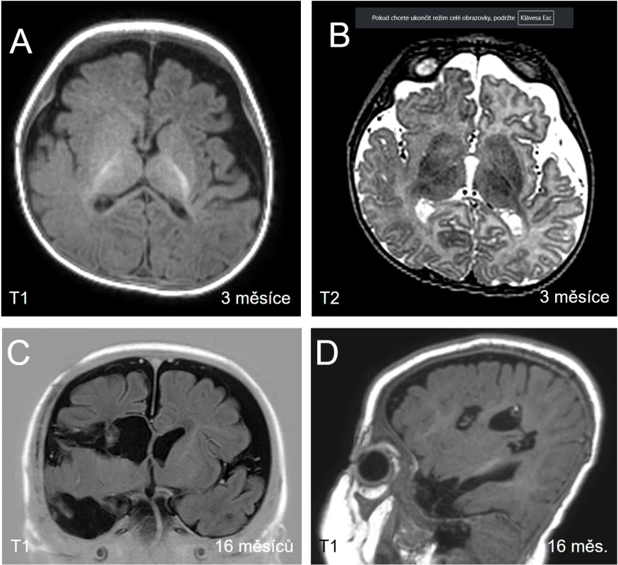 Pacient P2 z obr. 1 podstoupil hemisferotomii vpravo dle Schramma pro hemisferální fokální kortikální dysplázii typu IIa. (A, B) Předoperační snímky MR – T1 (A) a T2 (B), axiální projekce ve 3 měsících věku, patrné jsou diskrétní změna signálu bílé hmoty a horší diferenciace šedé a bílé hmoty v rozsahu celé pravé hemisféry; (C) pooperační snímky MR + FDG-PET, koronální projekce; (D) pooperační snímky MR – T1, sagitální projekce. Fig. 4. Patient P2 from Fig. 1 underwent a right hemispherotomy using the Schramm technique for hemispheric focal cortical dysplasia type IIa. (A, B) Preoperative MRI – T1-weighted (A) a T2-weighted (B) axial images at 3 months of age show subtle white matter signal abnormality and impaired grey– white matter diff erentiation involving the entire right hemisphere; (C) postoperative MRI T1-weighted + FDG-PET coronal images; (D) postoperative MRI – T1-weighted sagittal images.