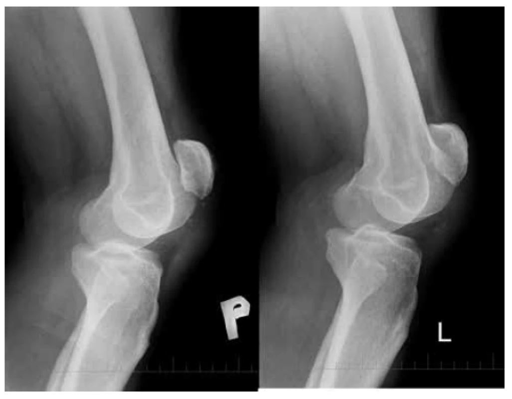 <i>Patella alta</i> (Insall-Salvati ratio= 1,84)
Bočná projekcia obidvoch kolien po úraze.<br>
  Fig. 1: <i>Patella alta</i> (Insall-Salvati ratio= 1.84)
Lateral view of both knees after injury.
