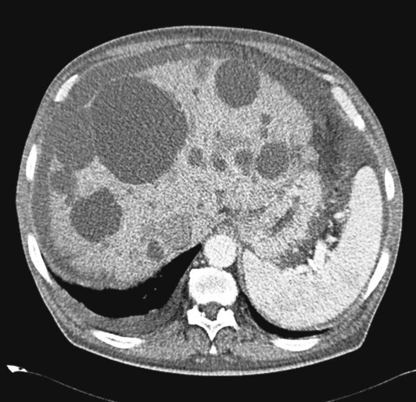 Polycystóza jater typu Gigot I. Vyšetření výpočetní tomografií s kontrastní látkou. Velikost největší 9 cm
Fig. 1. Hepatic polycystosis, Gigot’s type I. Contrast CT examination. The largest one measuring 9 cm