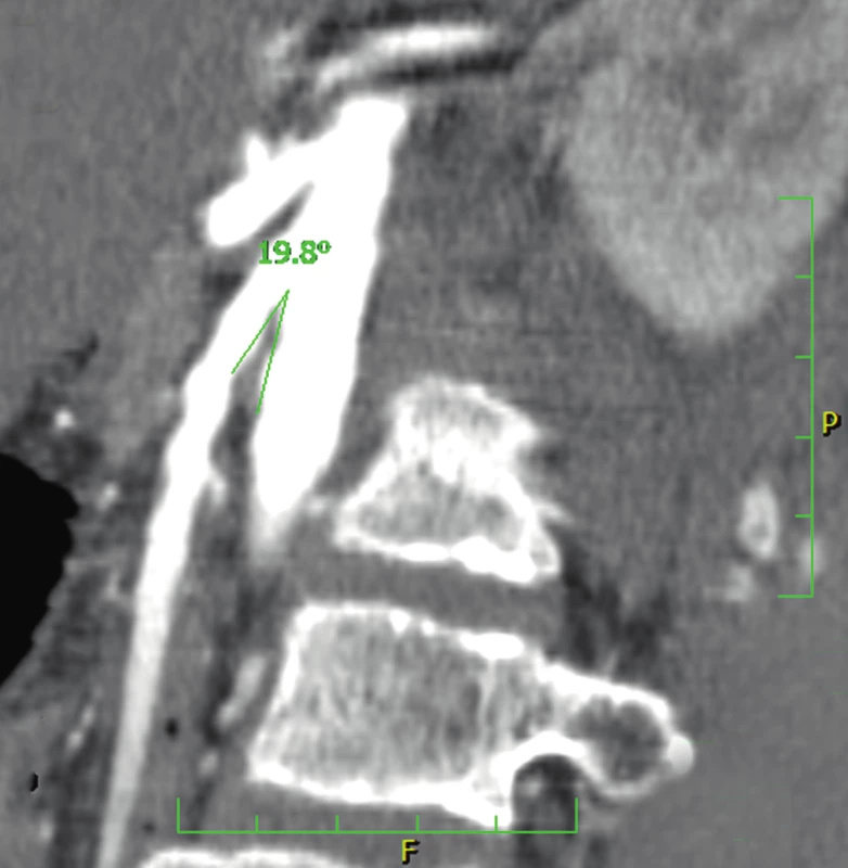 CT angiografie ukazující nápadné snížení úhlu mezi aortou a horní mezenteriální arterií u pacienta 1 (19,8°). (Obrazový materiál Oddělení radiologie Nemocnice Karviná, MUDr. Kupková).
Fig. 2. CT angiography showing signifiant narrowing of the angle between the abdominal aorta and the superior mesenteric artery (measuring 19.8°) (case report one).