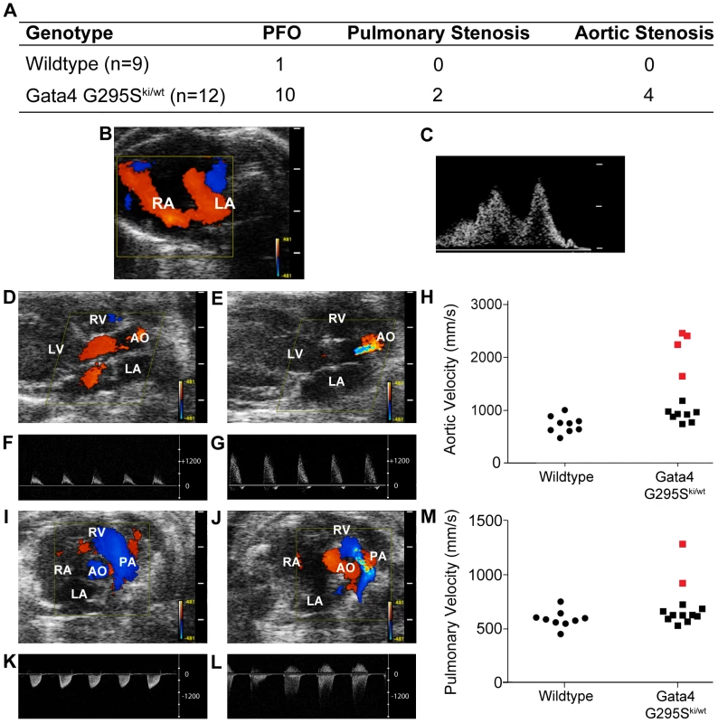 Atrial septal defects and semilunar valve stenosis in <i>Gata4 G295S<sup>ki/wt</sup></i> mice.