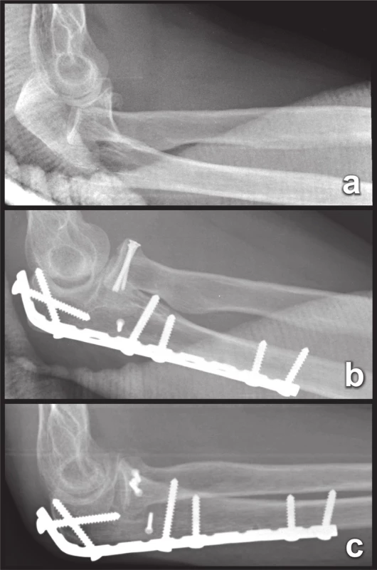 Osteosyntéza zlomeniny z obr. 12. a – žena, 38 r., luxační zlomenina proximálního předloktí Monteggiova typu (částečná zlomenina a zadní luxace hlavice radia a intraartikulární zlomenina proximální ulny), b – stav po operaci, c – stav 3 měsíce po operaci, anatomické zhojení zlomeniny.
Fig. 18: Internal fixation of fracture from Fig. 12. a – a woman, 38 y, fracture-dislocation of the proximal forearm of the Monteggia type (partial fracture and posterior dislocation of the radial head and intra-articular fracture of the proximal ulna), b – immediately postoperatively, c – 3 months postoperatively, healing in anatomical position.