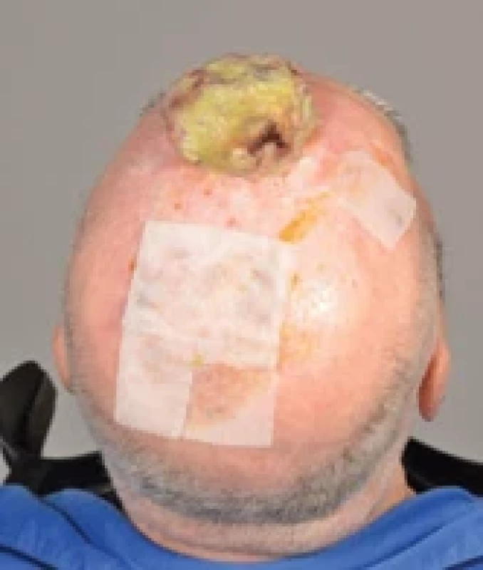 Pleomorphic dermal sarcoma of the scalp.