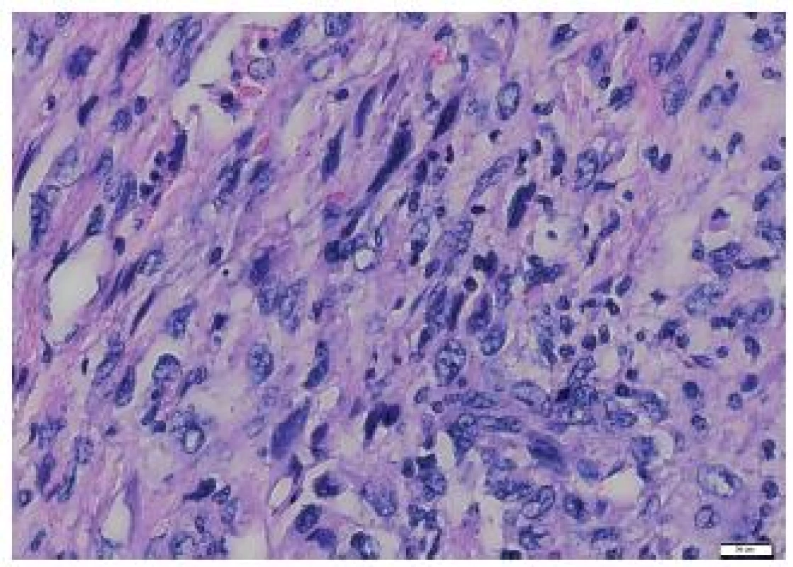 Elongated tumor cells of the metastasis to the heart, with no signs of storiform arrangement. HE, scale bar 20 μm.