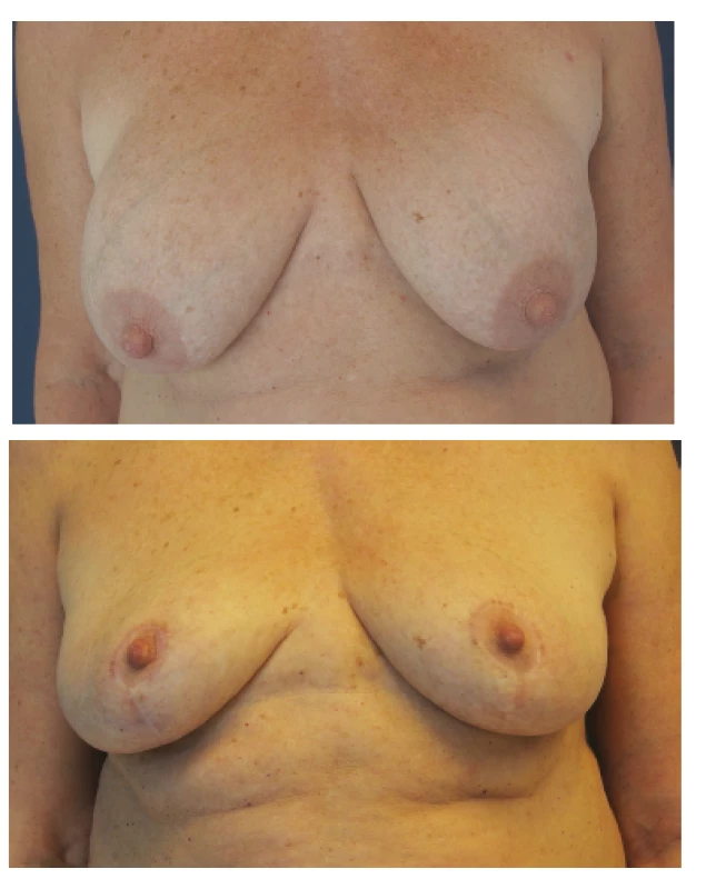 Modelace prsů u třiašedesátileté ženy
Fig. 5: Mastopexy in a 63 year old female