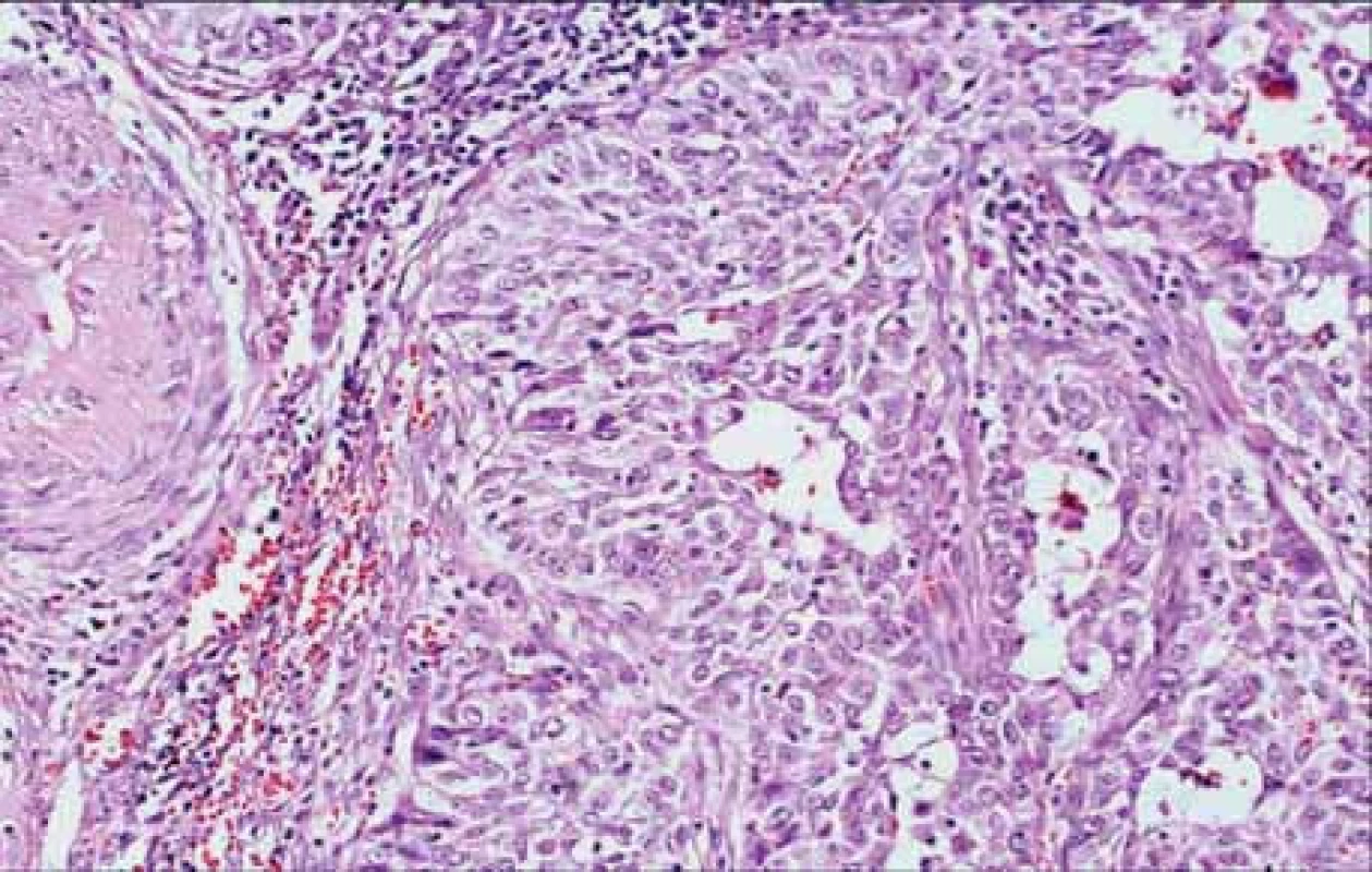Glassy-cell-karcinom. HE, 20×.