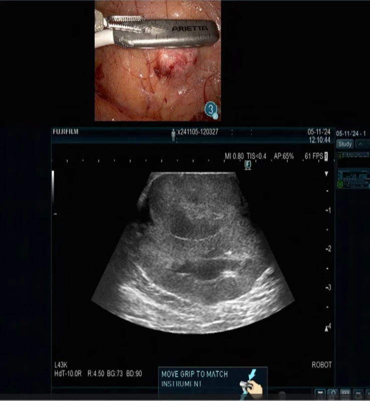  Intraoperační ultrazvuk.  Fig. 4. Intraoperative ultrasound. 