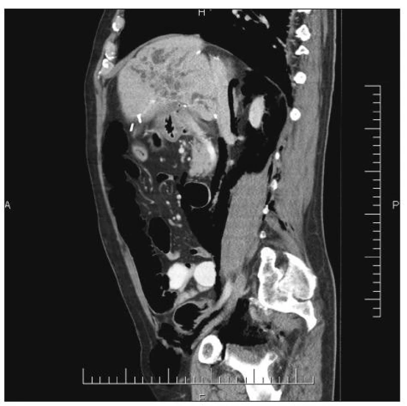 Pneumoretroperitoneum a vzduch putující retroperitoneem přes pravý tříselný kanál
Fig. 3. Pneumoretroperitoneum, the air passing through the retroperitoneum to the right inguinal canal