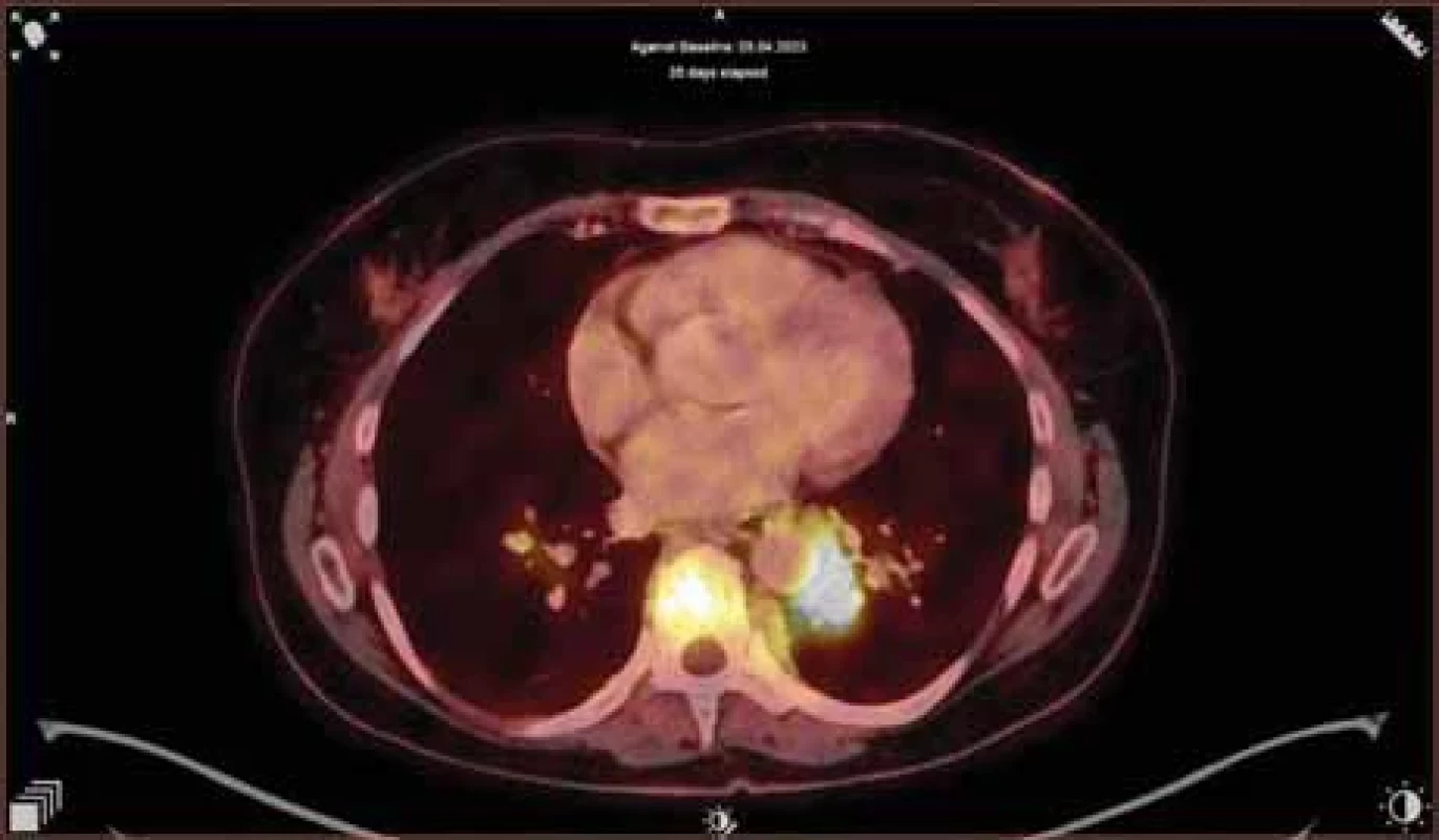 Transverzální řez hrudníku, na 18F-FDG-PET/CT je vidět zvýšená akumulace 18FDG v měkkotkáňovém ložisku S10 levé plíce s těsným vztahem k aortě (velikosti cca 28 × 26 × 35 mm, SUV max 10), dále v obratlové těle, sternu a v nepravidelných ložiscích obou prsou (do velikosti 15 mm).