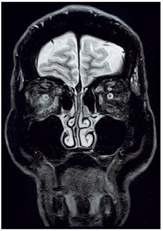 MRI očnic STIR, koronární řez – prosáknutí pojiva pravé orbity retrobulbárně