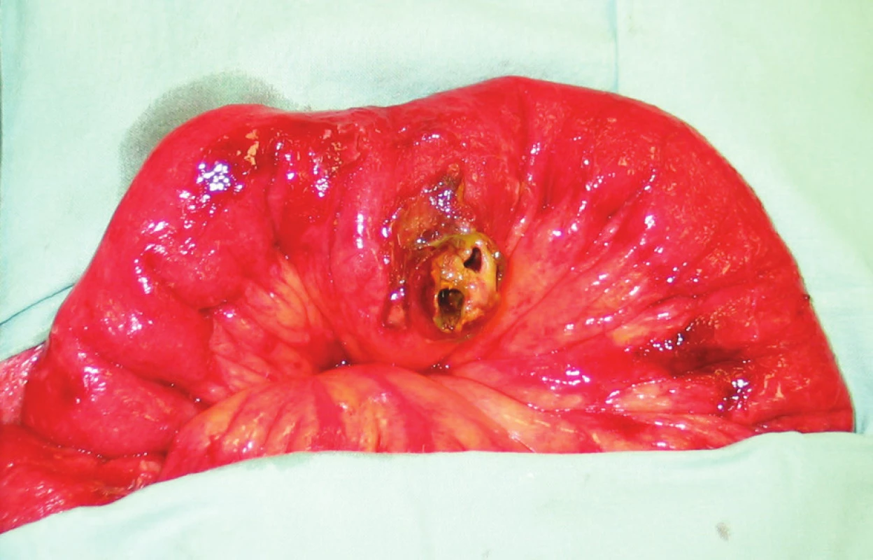 Perioperační nález
Fig. 1. Perioperative finding