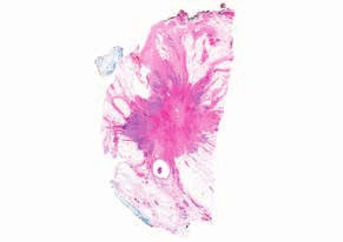 Histotopogram karcinomu prsu.
Cípaté okraje tumoru jsou zbarvené fialově.