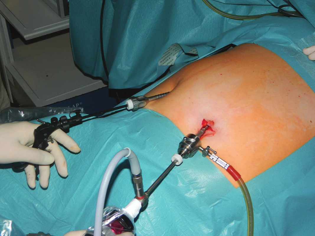 Zavedení trokáru z incize v mesogastriu
Fig. 1: Trocar insertion using an incision in the mesogastrium
