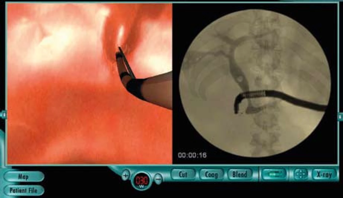 Modul pro ERCP. Pacient s choledocho- a cholecystolitiázou. Před papilotomií je nastaven smíšený proud a výkon 30 watt.
Fig. 7. Module for ERCP. Patient with common bile duct and gallbladder stones. Blended current and 30 W power are set prior to papillotomy.