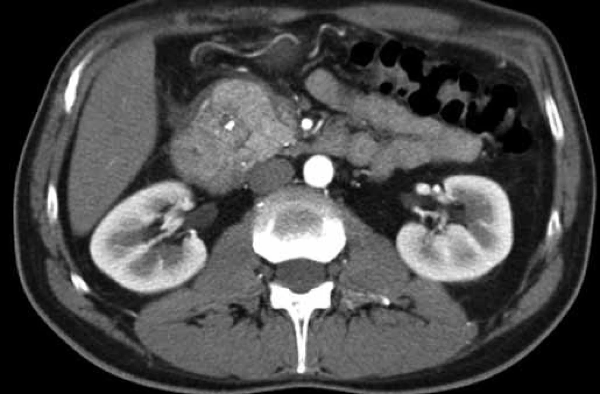 CT finding of a focally changed pancreatic head in the ‚groove‘ region and the adjacent duodenal wall (patient 1).
Obr. 2. CT obraz fokálne zmenenej hlavy pankreasu v oblasti „žliabku“ a priľahlej stene duodéna (pacient č. 1).
