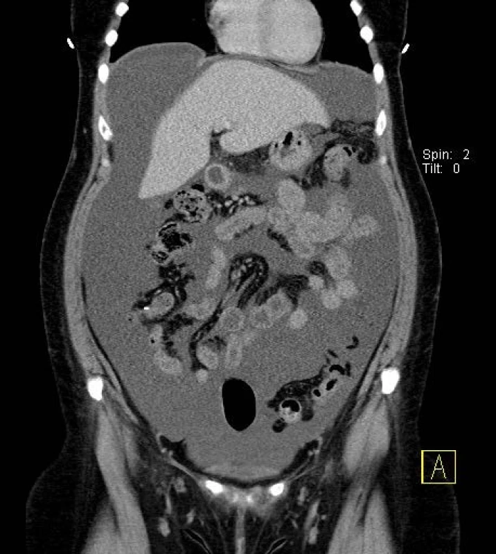 Dutina břišní naplněná močí
Fig. 1. Abdominal cavity filled with the urine