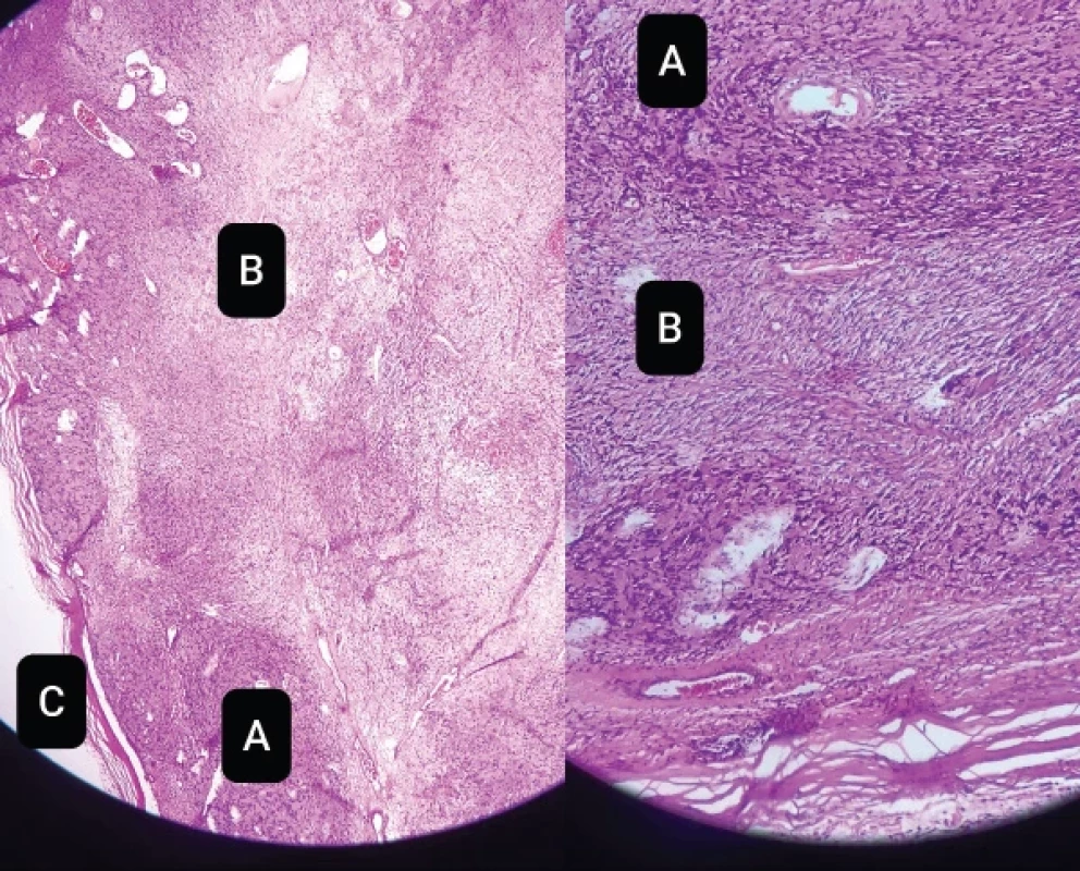 Low (left) and high (right) microscopic magnification of the lesion showing a biphasic pattern of hypercellular (Antony A) and hypocellular (Antony B) areas with a surrounding capsule (C). H & E: Hematoxillin and Eosin