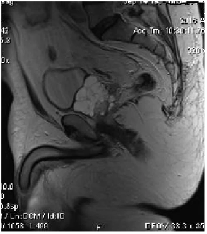 MRI sagitální řez – cystický nádor prostaty
Fig. 1 MRI sagittal plane – cystic tumor of prostate