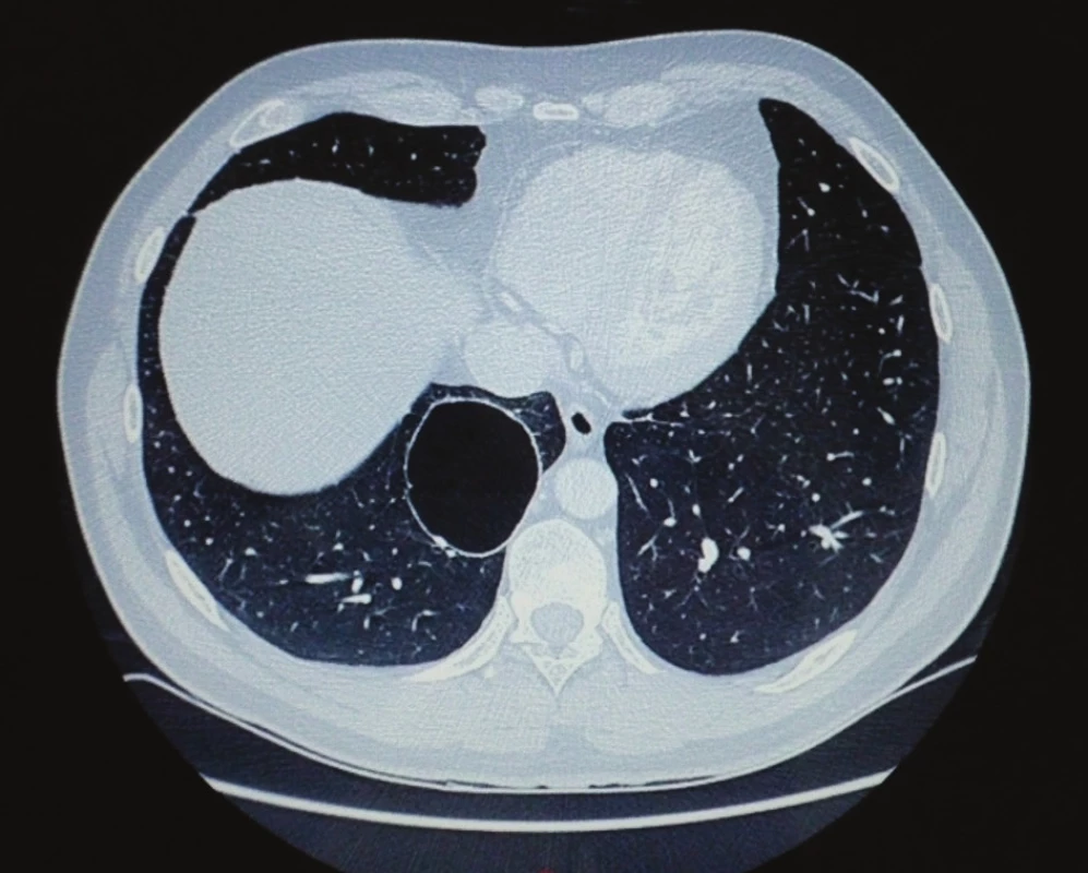 CT hrudníka – v 10 segmente vpravo prítomné tenkostenné ložisko vyplnené vzduchom veľkosti do 7 cm, bez prítomnosti patologického obsahu, mediastinum bez lymfadenopatie
Fig. 2: CT of the chest – in segment 10 on the right side there is a thin-walled deposit filled with air, the size up to 7 cm, without a presence of pathologic content, mediastinum without lymphadenopathy