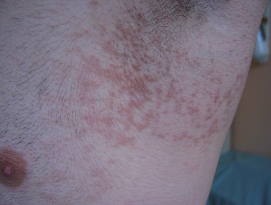 Případ 1: papillomatosis reticularis et confluens.