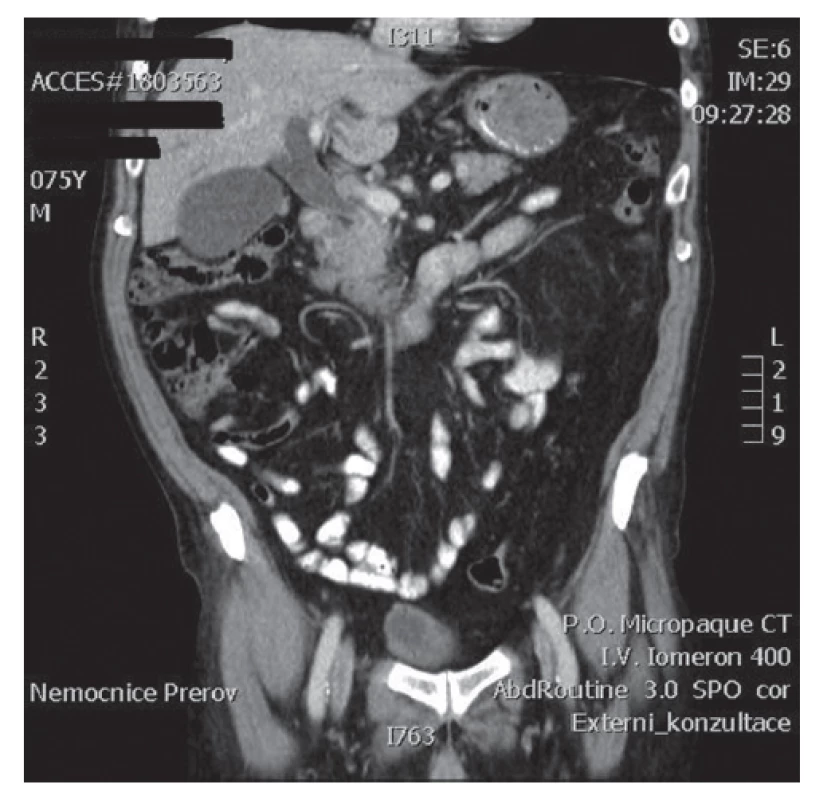 Kazuistika 2, CT pankreatu – dilatace žlučových cest bez zjevného tumoru
Fig. 1: Case 2, CT of the pancreas – dilated bile ducts; no signs of the tumor