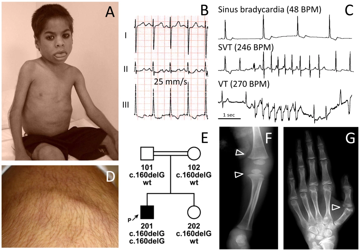 Phenotype of patient FI:201 from Oman.