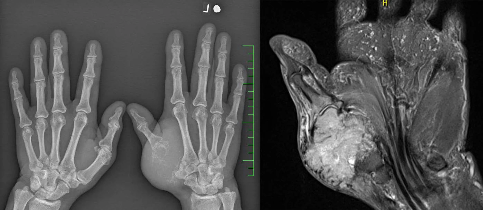 Rtg (vlevo) a MRI (vpravo): metastáza světlobuněčného renálního karcinomu v záprstní kosti palce levé ruky
Fig. 1. X-ray (left) and MRI (right): the metastasis of a clear cell renal cell carcinoma in the left thumb