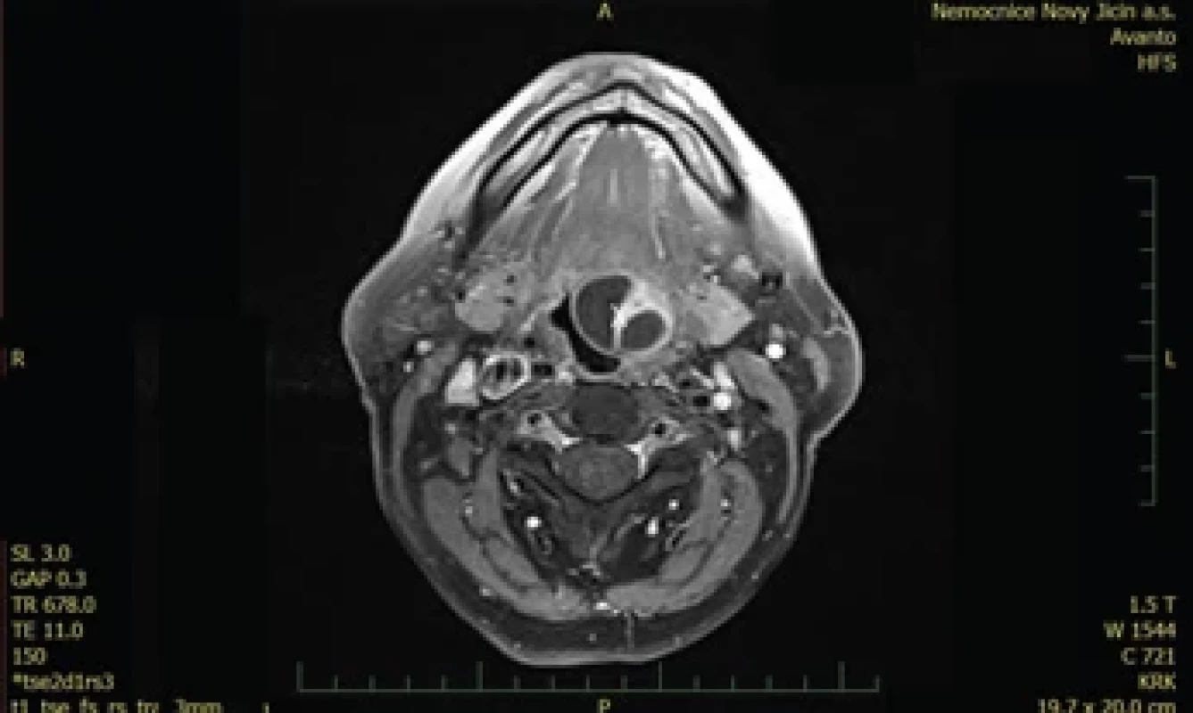 MR vyšetření (T1), axiální řez, tumor označen křížkem.MRI examination (T1), axial section, tumor marked with a cross.