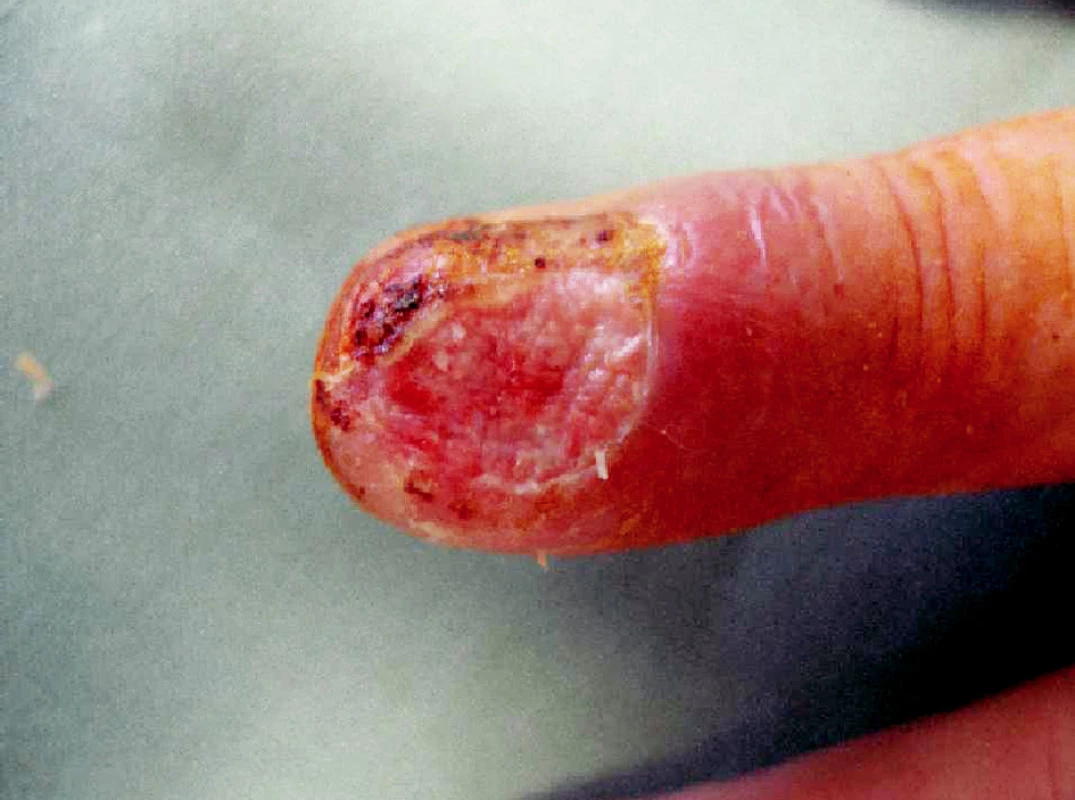 Subunguální spinocelulární karcinom – stav po ablaci nehtu
Fig. 1. Subungual spinocellular carcinoma – after nail ablation
