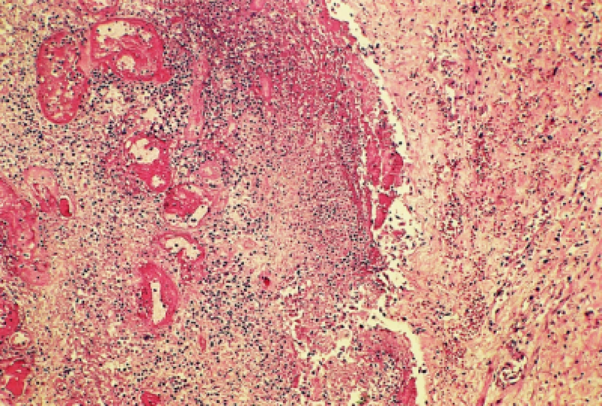 Nekrotický polyp s tromby v cévách je difuzně zánětlivě infiltrovaný (barvení HE, zvětšení 25×)