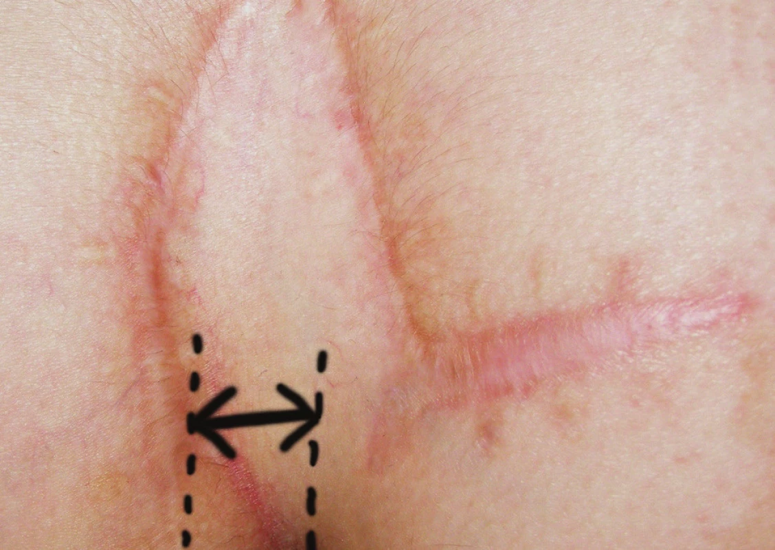Fotografia rany 12 mesiacov po operácii – modifikovaný Limbergov lalok (šípka naznačuje vzdialenosť spodného pólu plastiky od mediálnej roviny).
Obr. 4. Photograph of wound 12 months after surgery – modified Limberg flap (arrow shows distance of down corner of flap and medial line).