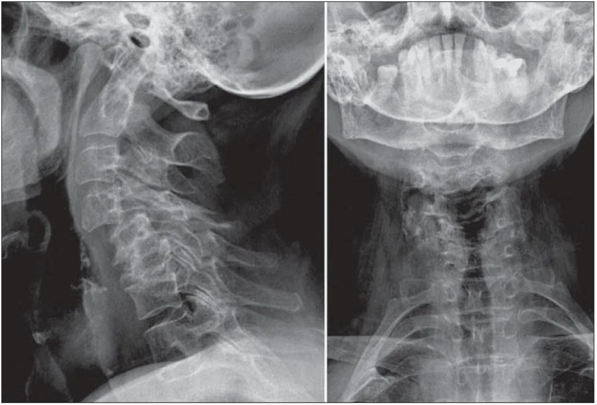 Vstupní radiologický nález schodovité defigurace krční páteře C4/5 a C5/6 v terénu skoliotické deformity v rovině koronární.