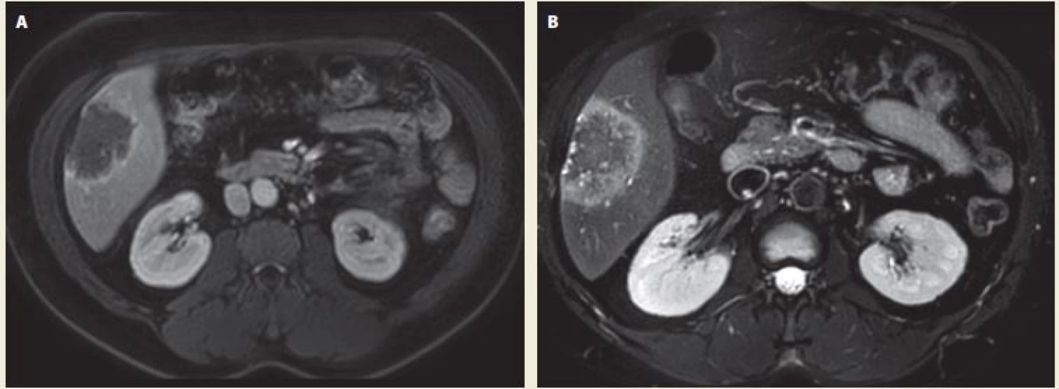 Echinococcal liver lesion on MRI – A. T1 weighted image in portal phase of contrast enhancement – axial scan;
B. T1 weighted image – axial scan. In the right liver lobe in the 5th segment there is a post-contrast T1 hypointense hypovascular
focal lesion with hyperintense margin of hyperperfusion, the centre of the lesion remains unenhanced (A). On the
T1 weighted image the lesion is hypointense, on the margin we can see small hyperintense areas – small cystic formations (B).
Source: Department of Radiology, Hospital Kyjov.<br>
Obr. 1. Echinokokové postižení jater na MR – A. T1 vážená sekvence po podání kontrastní látky v portální fázi v axiální rovině;
B. T1 vážená sekvence v axiální rovině. V pravém laloku jater v 5. segmentu je postkontrastně v portální fázi T1 hypointenzní
hypovaskularizované ložisko s hypervaskularizovaným hyperintenzním lemem (A). Na T1 je léze hypointenzní, po obvodu patrny
drobné hyperintenzní okrsky v rámci drobných cystických kolekcí (B). Zdroj: Radiologické oddělení, nemocnice Kyjov.
