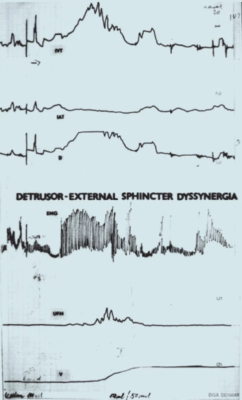 Synchronní záznam urodynamického vyšetření při DESD (křivky shora: P<sub>ves</sub>, P<sub>abd</sub>, P<sub>det</sub>, EMG sfinkteru, UFM, mikční objem).