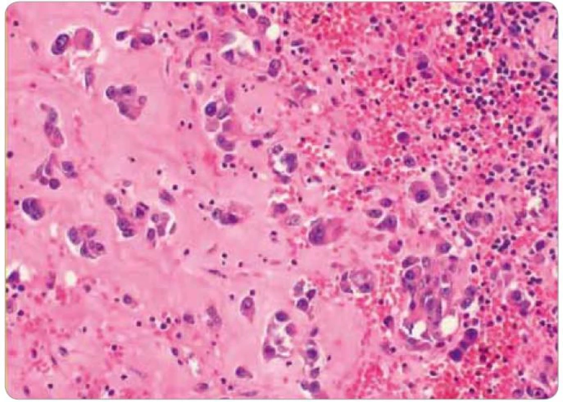 Histologický obrázek hemangiosarkomu (pacient č. 1). Pod epidermis se nachází sklerotická až hyalinně přeměněná dermis s četnými ložisky hemoragií. Pouze místy lze zastihnout izolované či v drobných hnízdech uspořádané epiteloidně vyhlížející elementy simulující recidivu karcinomu. Tumor byl na několik cytokeratinů (epitelový marker) negativní, a naopak nádorové elementy exprimovaly CD31, CD34 a FVI (cévní markery), což vedlo k diagnóze angiosarkomu.