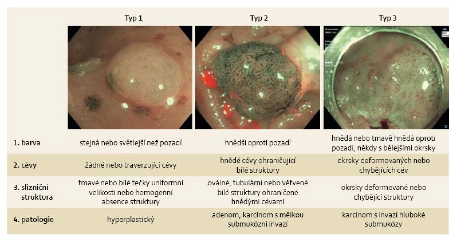 NICE klasifikace časných kolorektálních neoplazií.
Fig. 1. NICE classification of early colorectal neoplasms.