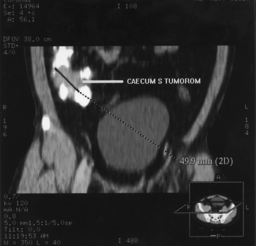 CT rekonštrukcia tumoru céka
Pic. 2. A CT reconstruction of the caecal tumor